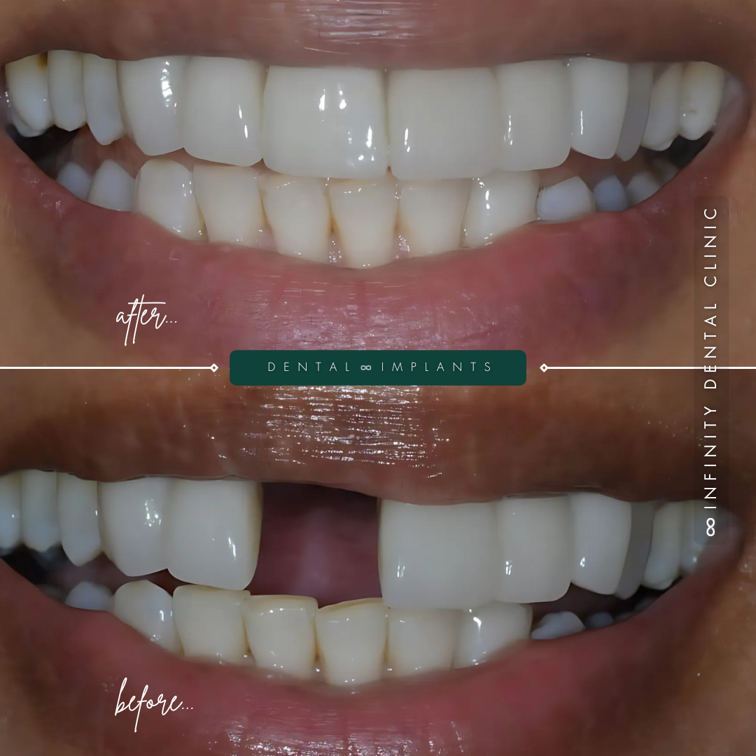 Full Arch Before and After (5)