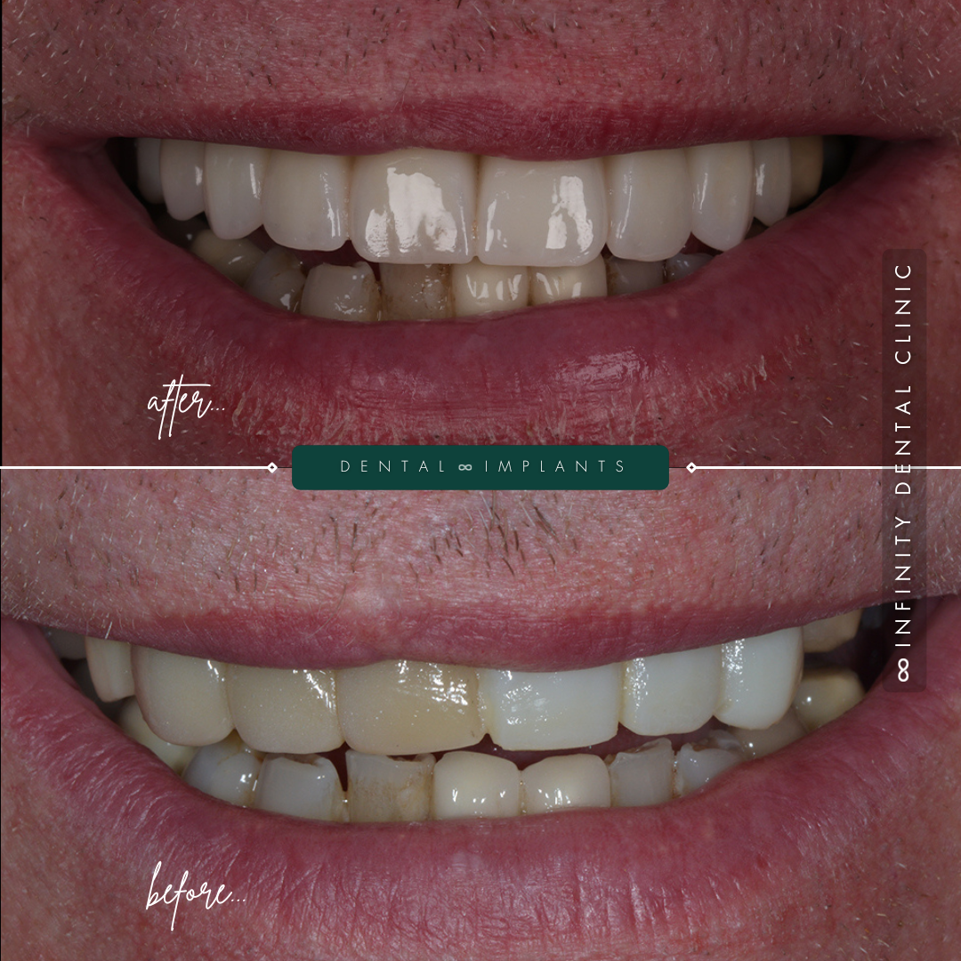 Full Arch Before and After (6)