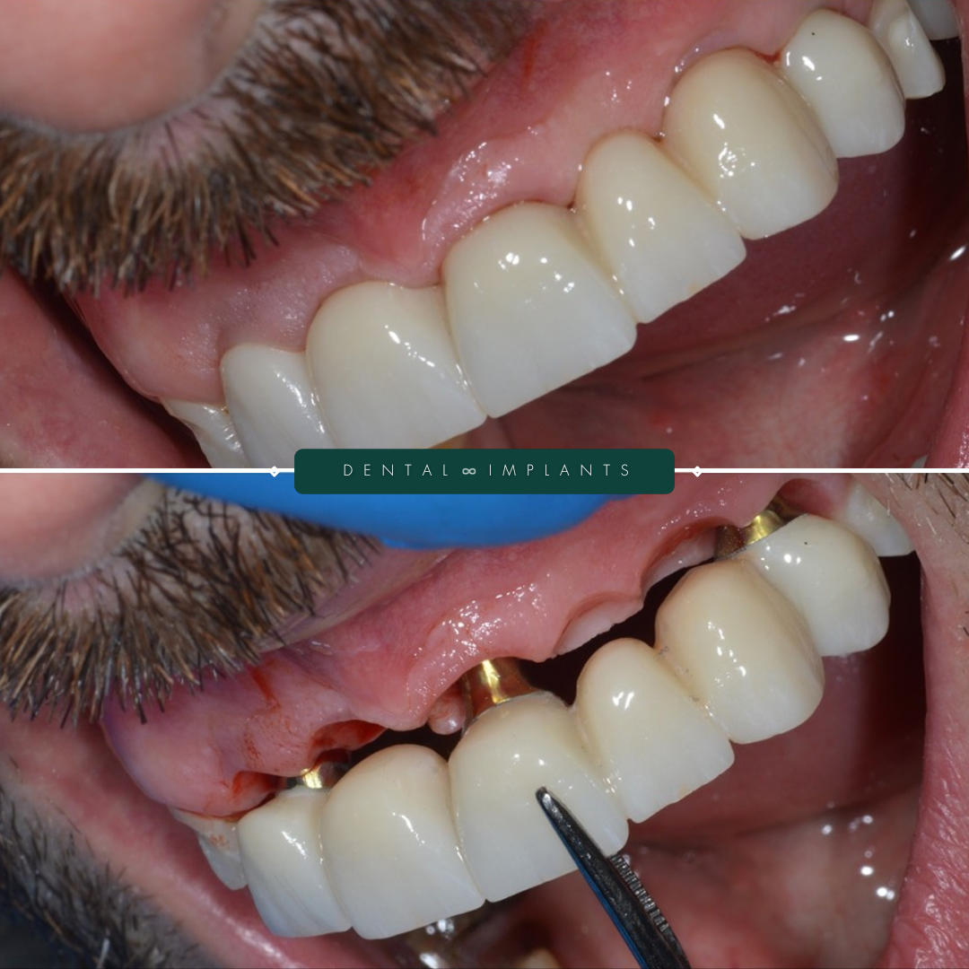 TEETH TRANSFORMATIONS - 2025-02-24T093706.610 TEETH TRANSFORMATIONS - 2025-02-24T093706.610
