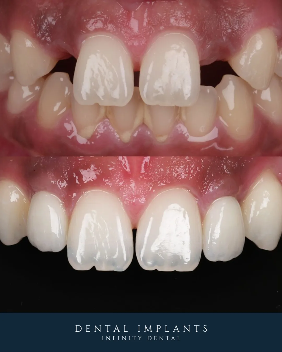 Patient smiling after dental implant treatment