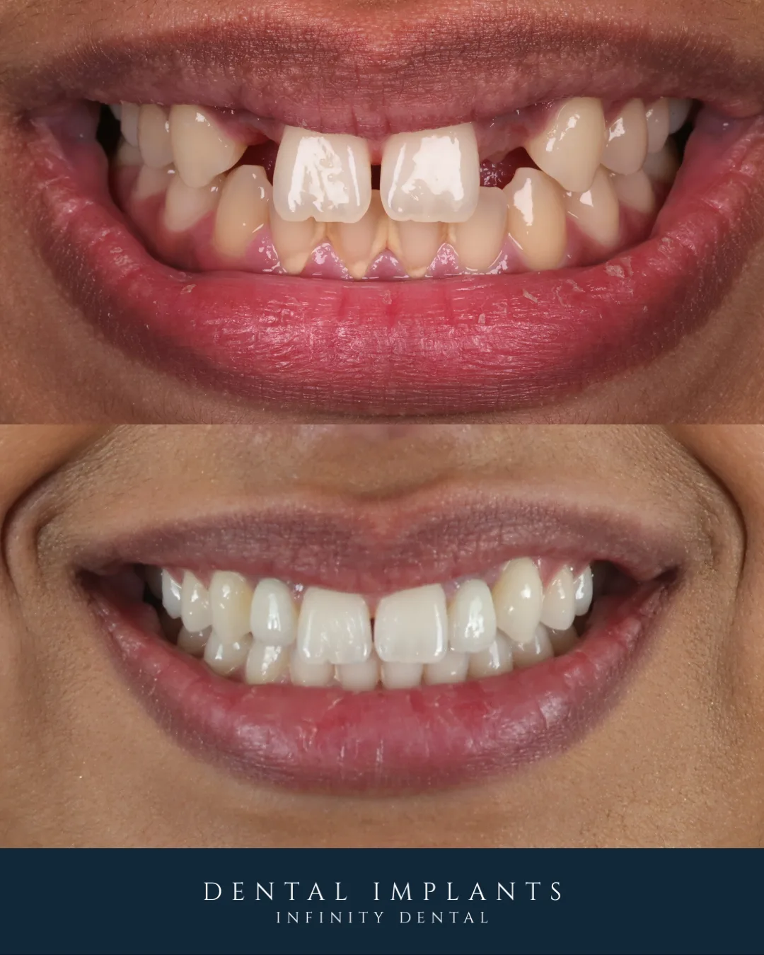 Dental implant treatment planning at Infinity Dental Clinic