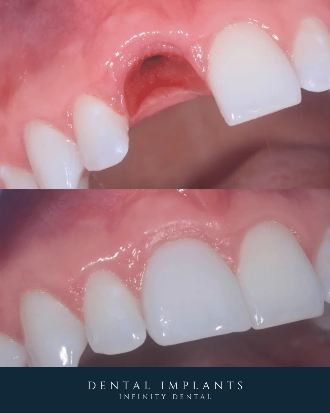 Before and after dental implant restoration