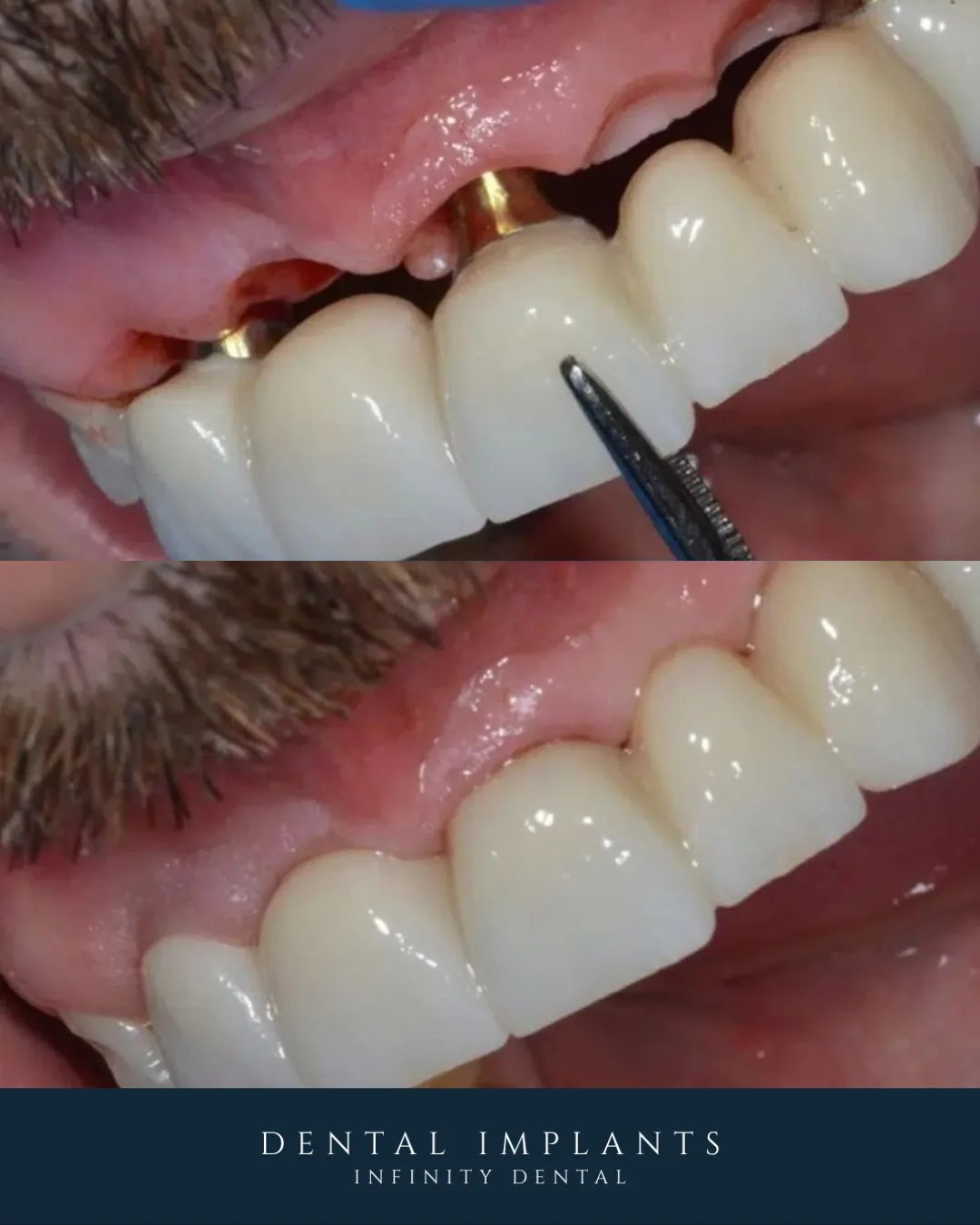 Dental implant replacement illustration