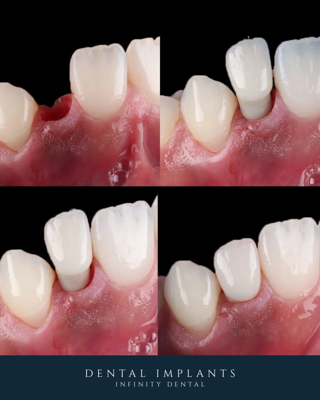 Dental implant treatment stages replacing a missing tooth