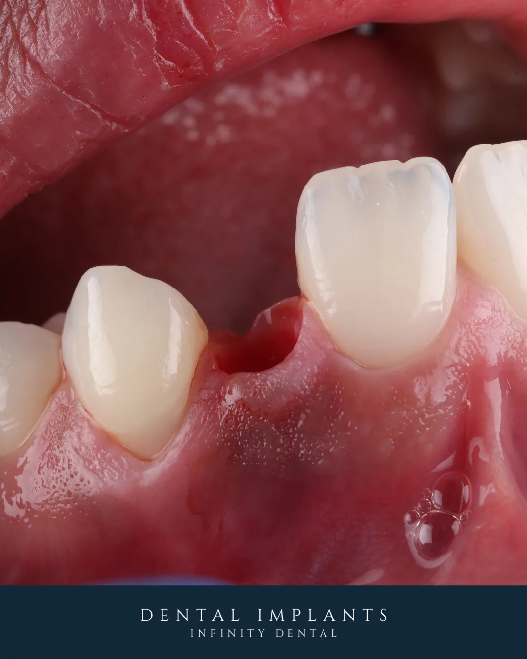 Missing tooth and surrounding gum tissue before dental implant treatment