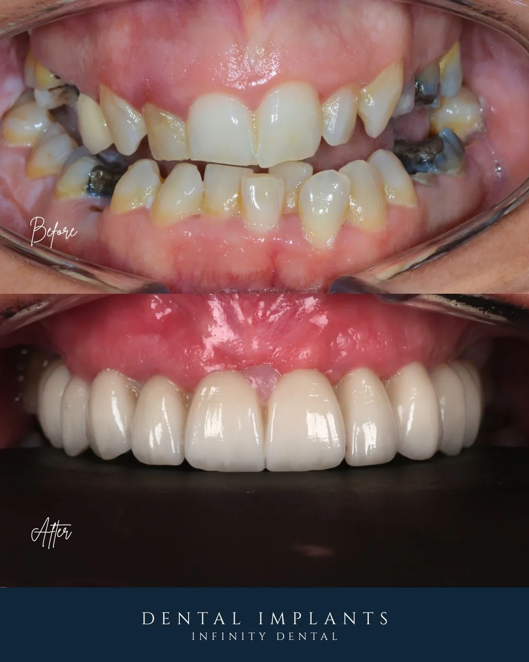 Before and after full arch implant transformation