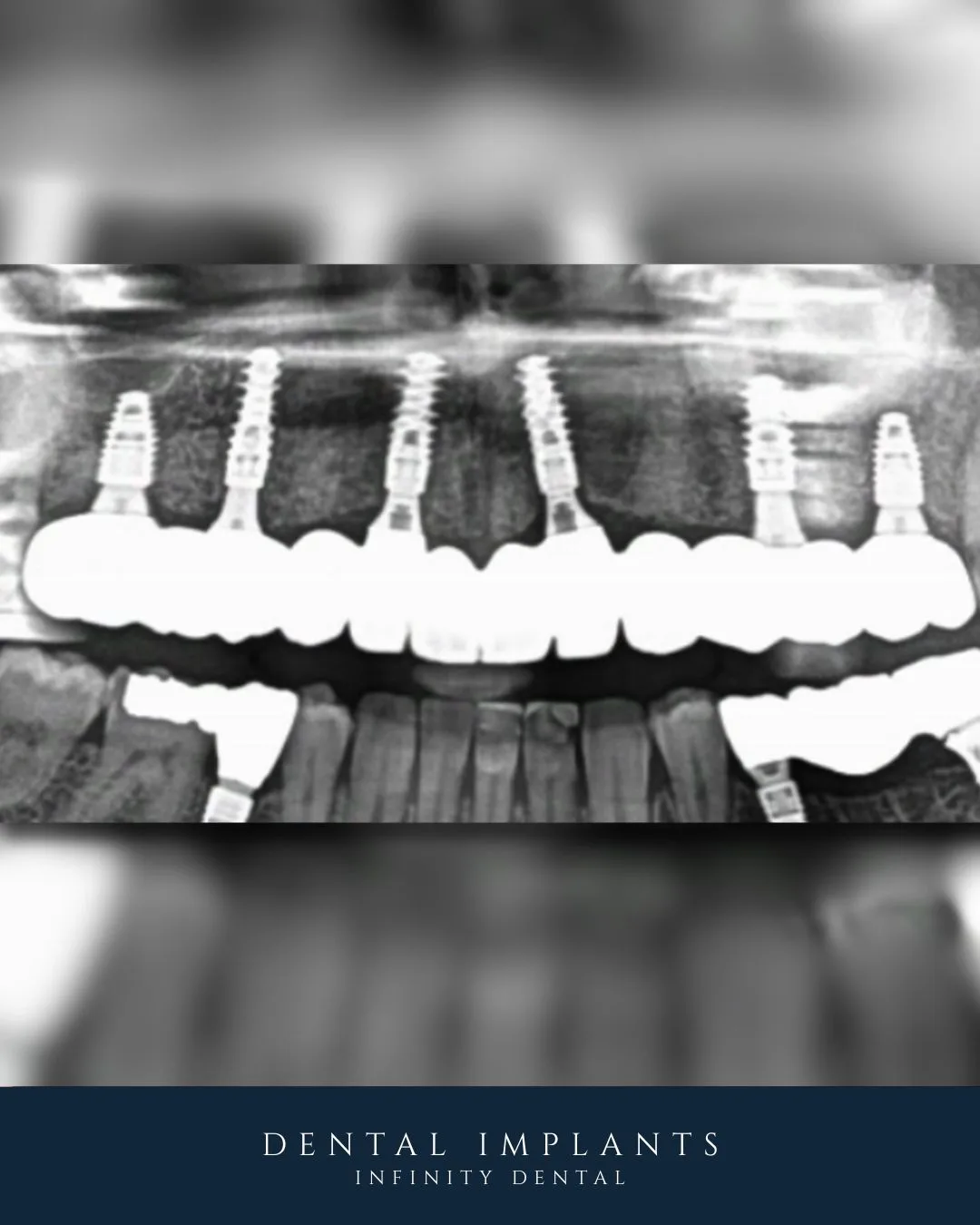 Full arch dental implants shown on a panoramic X-ray