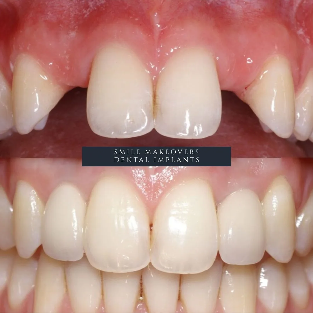 Before and after Same Day Teeth smile transformation