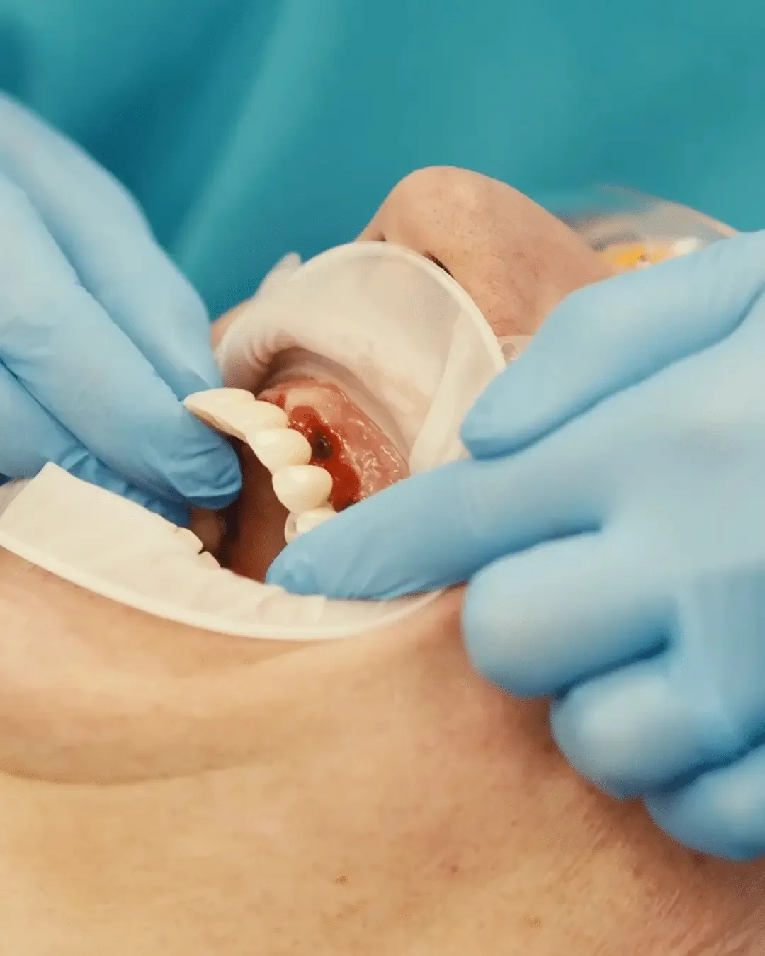 Full Arch Same Day Teeth treatment planning