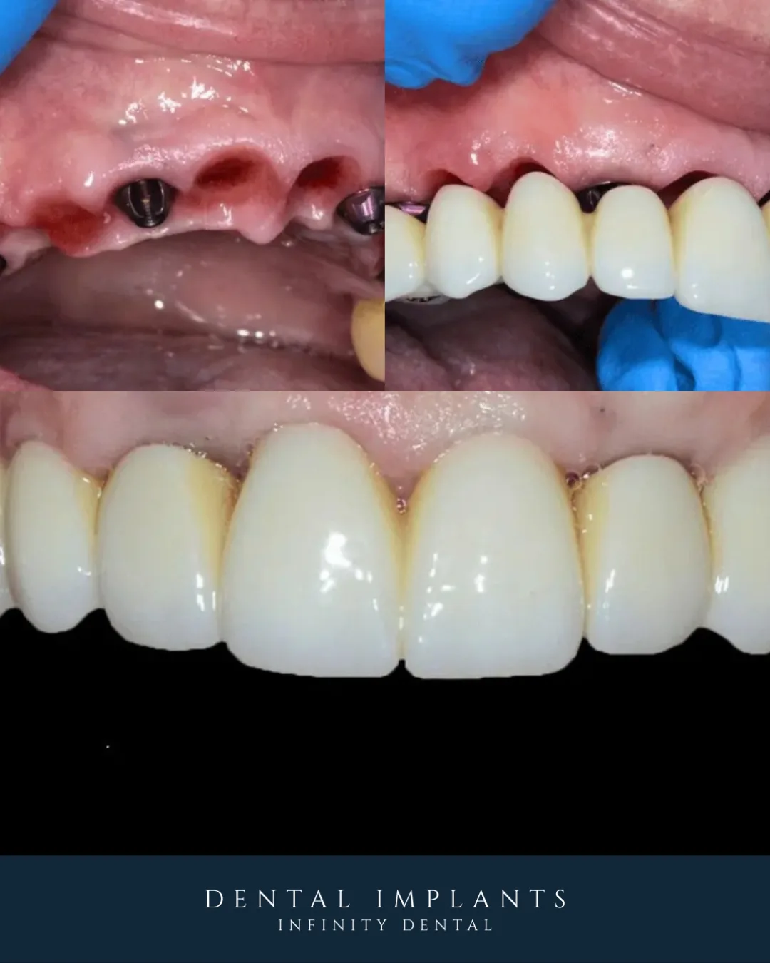 All-on-Four dental implant planning for same day teeth