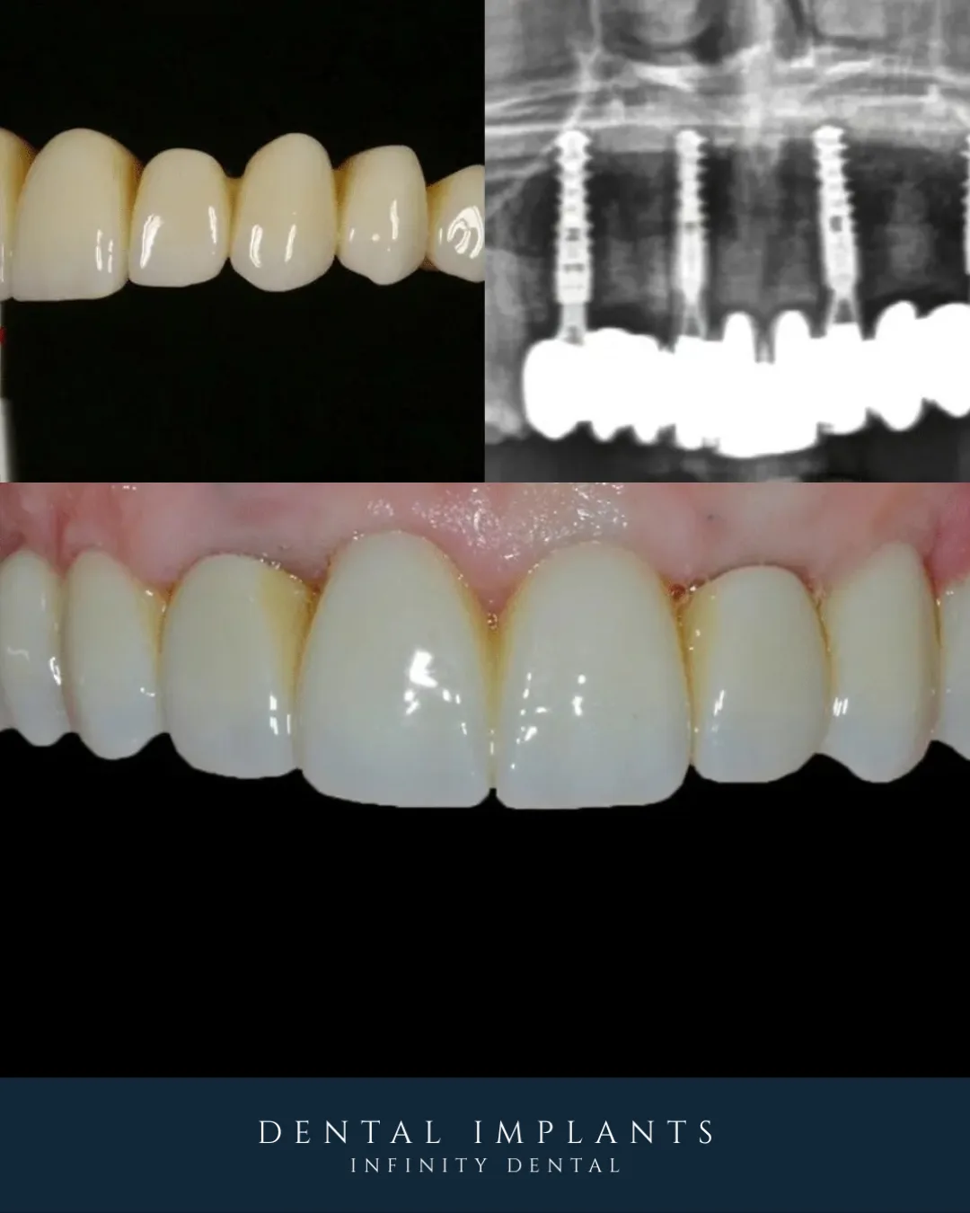 All-on-Six full arch dental implant restoration