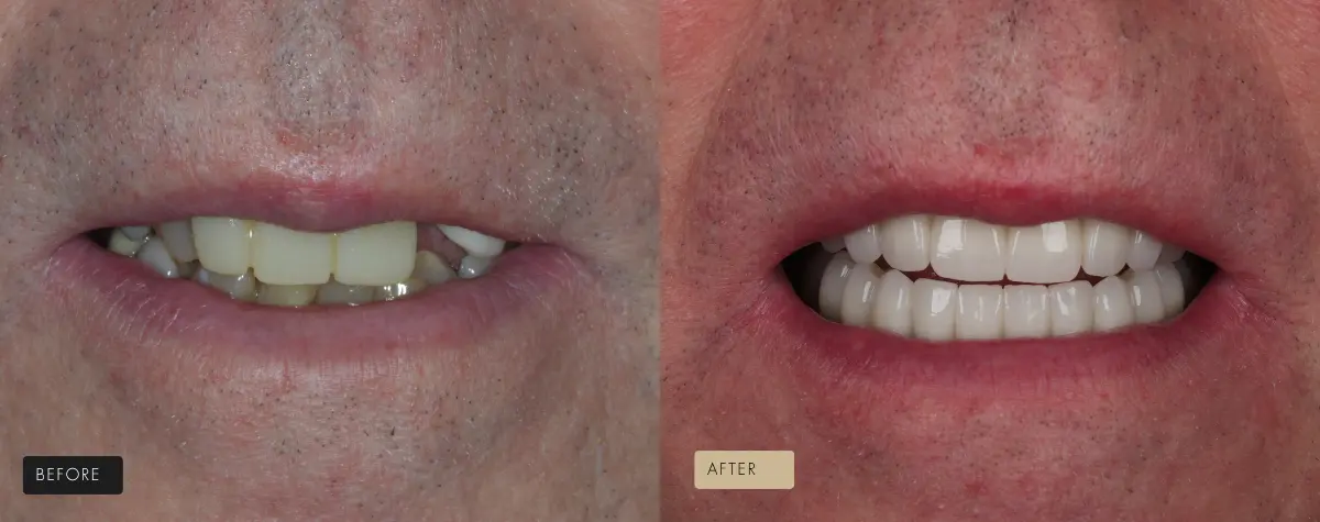 Before and after dental implant treatment