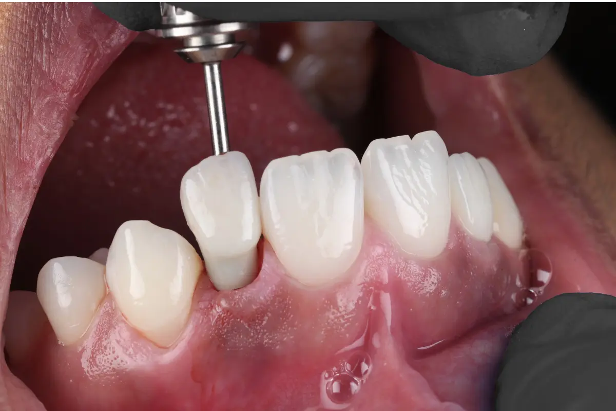 Placeholder image for single implant treatment