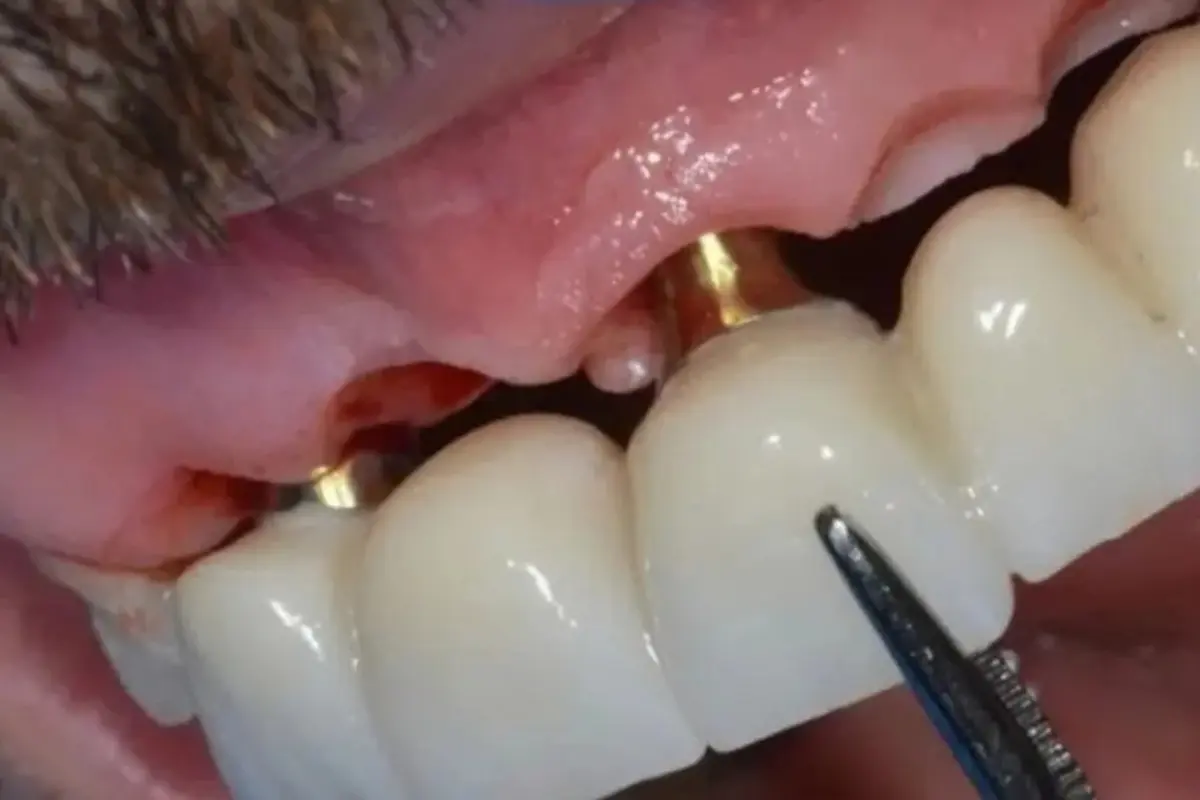 Placeholder image for multiple implant treatment