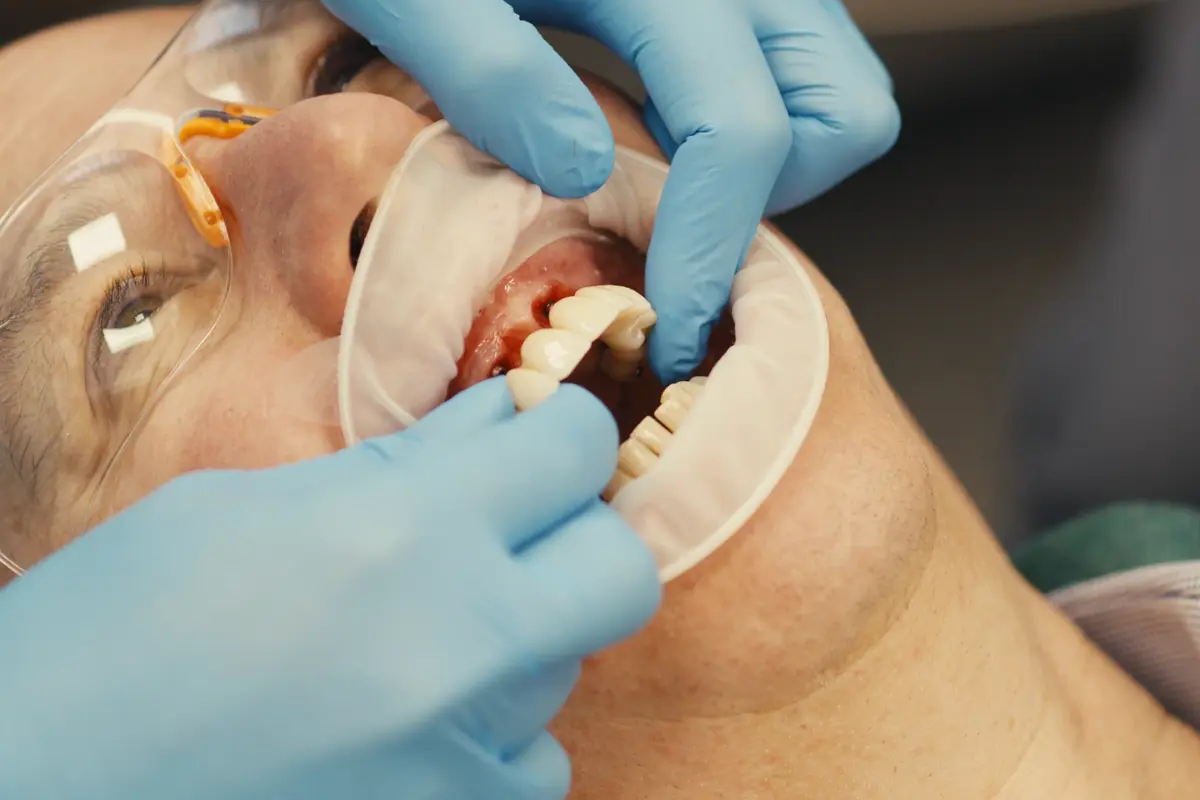 Placeholder image for full arch implant treatment