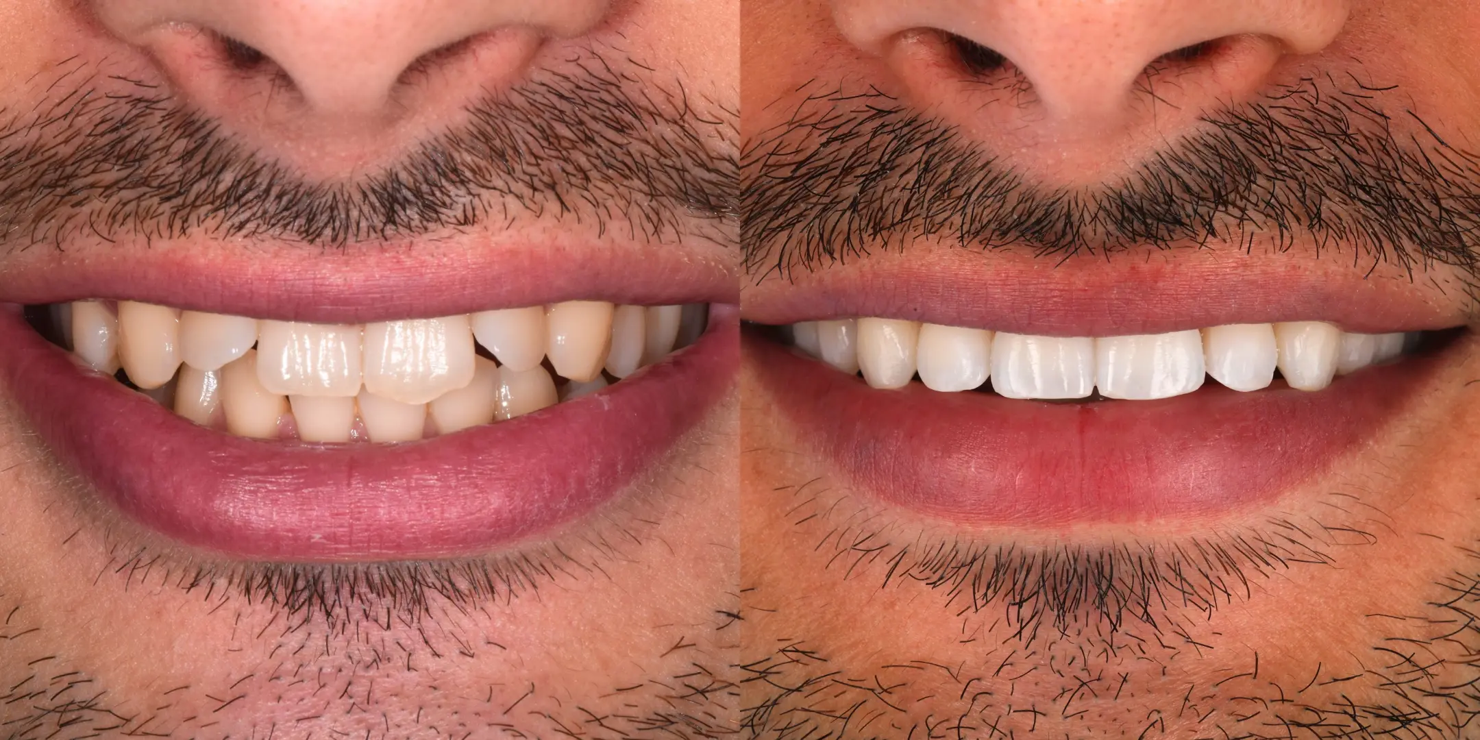 Approved smile transformation example