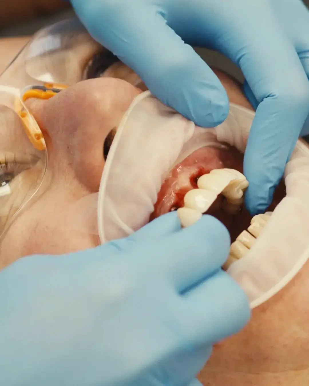 Dental implants